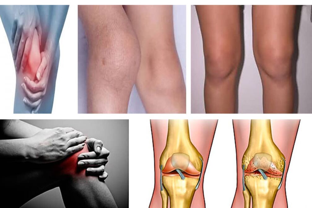 Symptoms of knee osteoarthritis